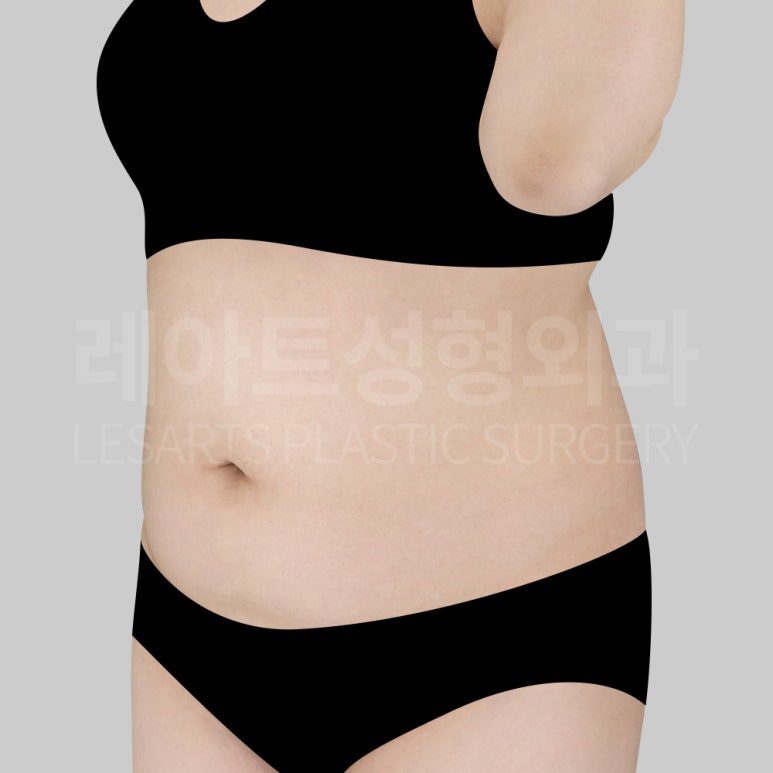 c-abdominal-liposuction-post13-03