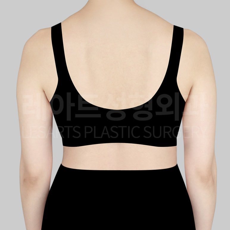 c-arm-liposuction-post12-02