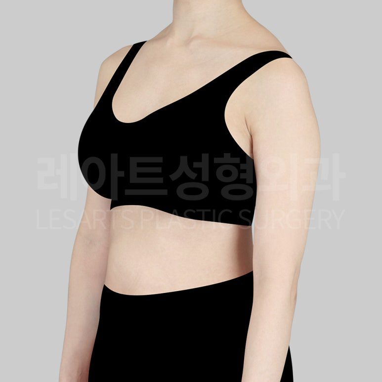 c-arm-liposuction-post12-03