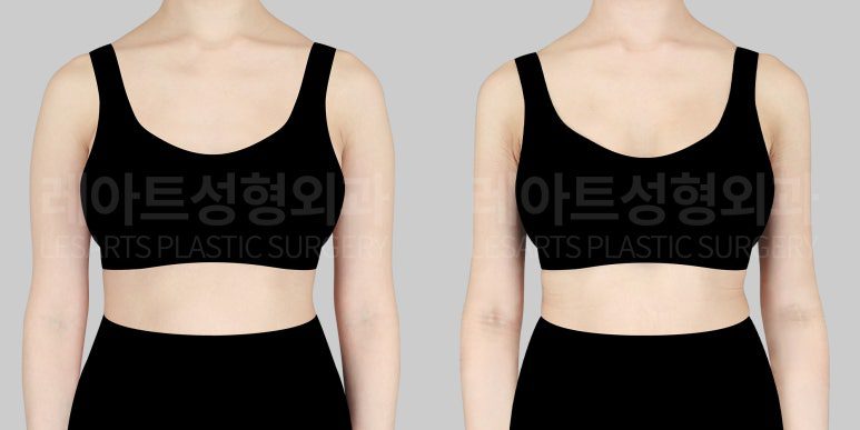 팔 지방흡입 전후사진