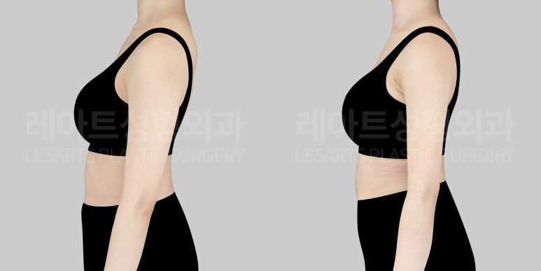 팔 지방흡입 전후사진 - 레아트 성형외과
