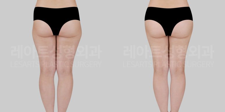 골반 지방이식 전후사진 - 레아트 성형외과