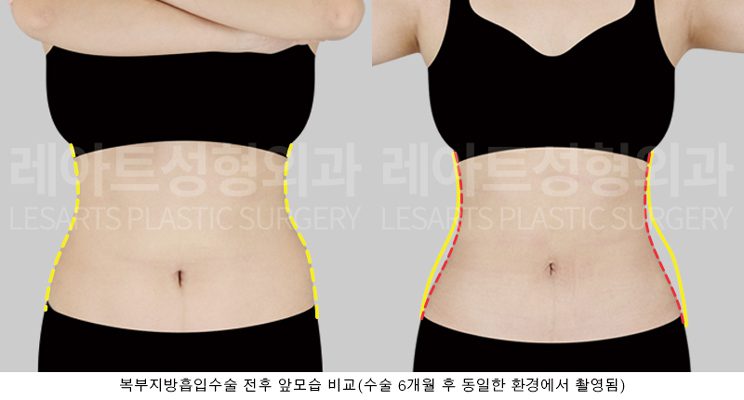 복부 지방흡입 전후 사례