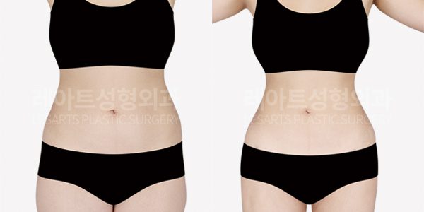 복부 지방흡입 전후 사진 레아트 성형외과