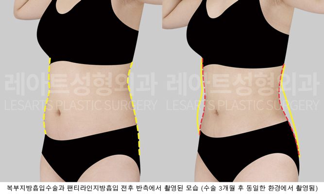 복부 지방흡입 실제 사례