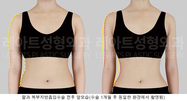 예비 신부 팔 지방흡입 전후 사진 - 레아트 성형외과