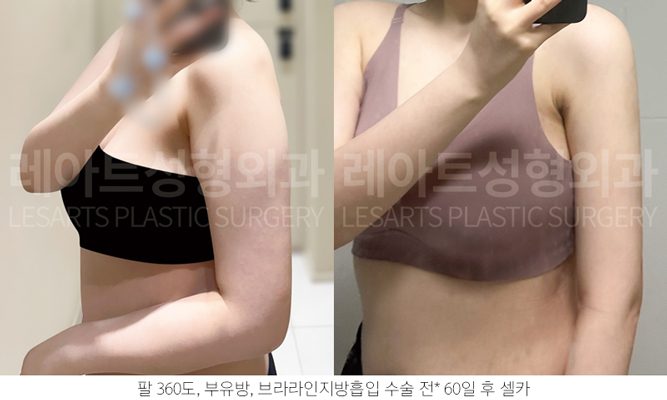 상체 지방흡입 전후사진 - 레아트 성형외과