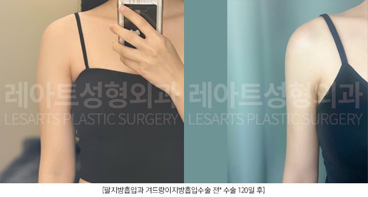 팔 지방흡입 셀카사진