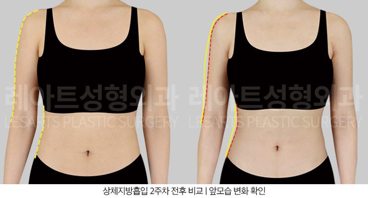 팔지방흡입 2주후 전후사진