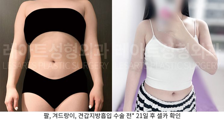 팔 지방흡입 2개월 후 셀카사진 - 레아트 성형외과