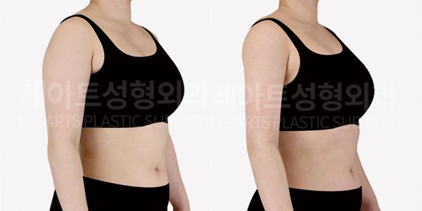 팔 지방흡입 전후사진