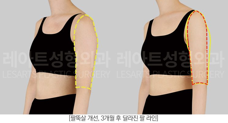팔 지방흡입 전후사진 일자팔 레아트 성형외과