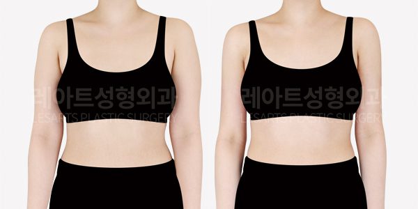 팔 지방흡입후 전후사진 - 레아트 성형외과