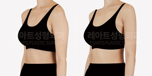 팔 지방흡입 전후사진 - 레아트 성형외과