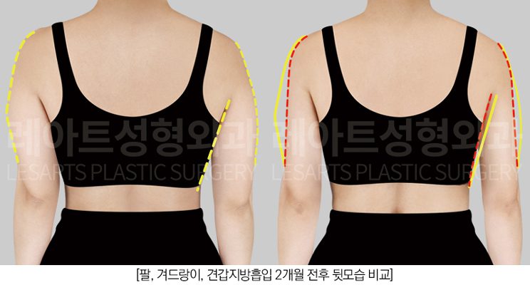 팔 지방흡입 후 뒷모습