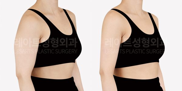 팔 지방흡입 전후사진 레아트 성형외과