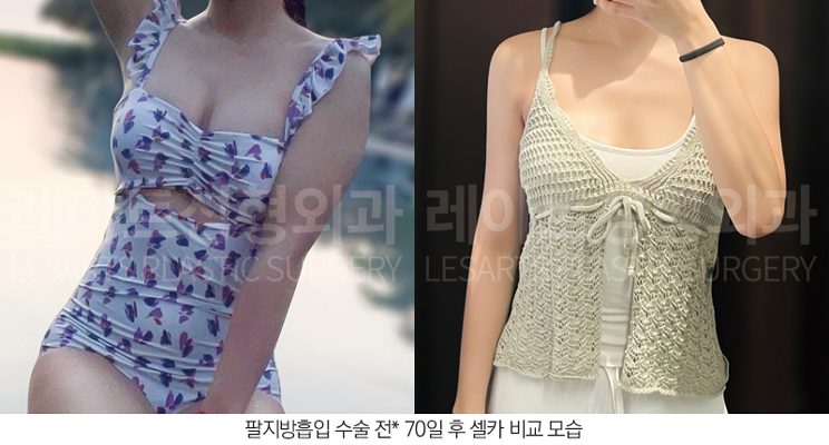 팔 지방흡입 수술 후 셀카사진