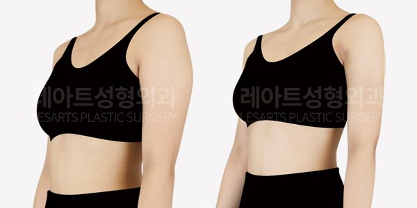 팔 지방흡입 전후 사진