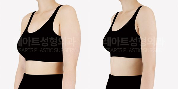 팔 지방흡입 전후사진 레아트 성형외과