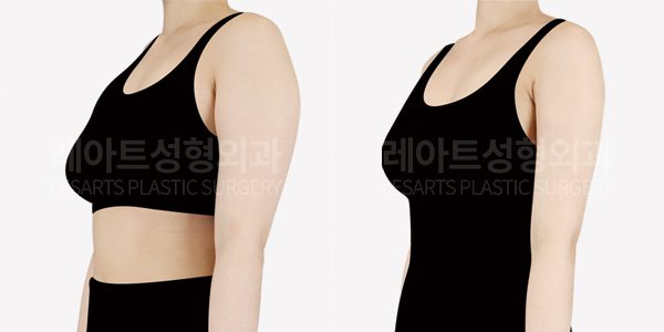 팔 지방흡입 전후사진