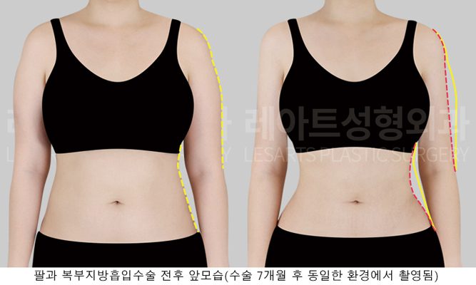 예비신부 팔 지방흡입 전후사진