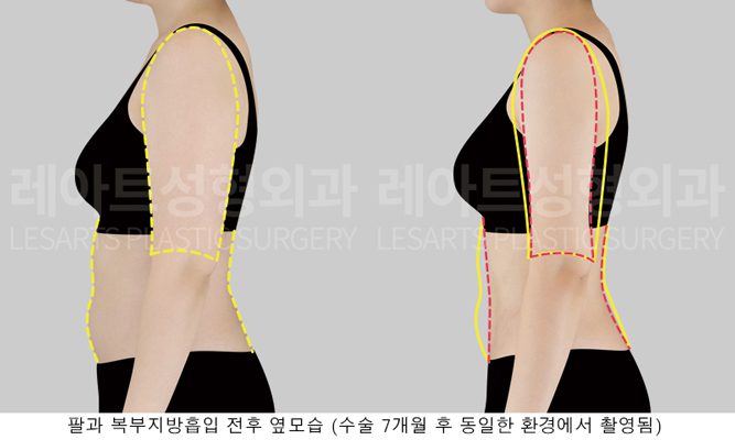 팔 지방흡입 옆모습 전후사진