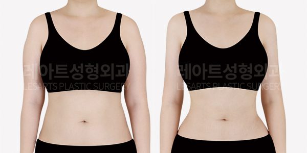 예비신부 복부 지방흡입 전후사진