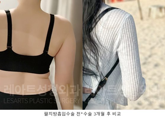 팔 지방흡입 레아트성형외과