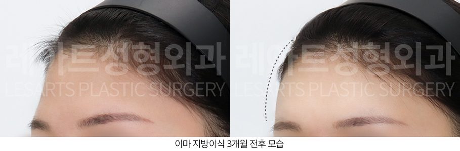 이마 지방이식 전후사진 레아트 성형외과
