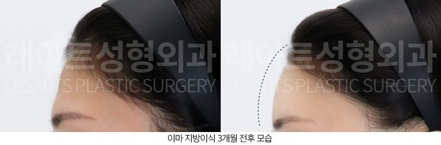 이마 지방이식 전후사진