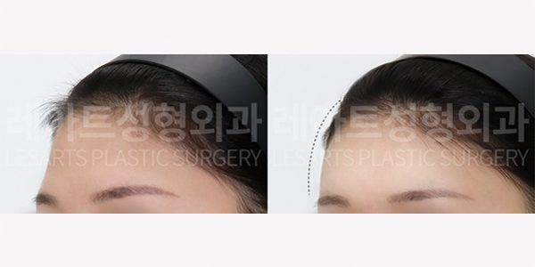 얼굴 지방이식 전후사진