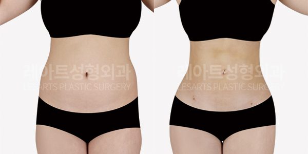 고관절 지방이식 + 복부 지방흡입 전후사진