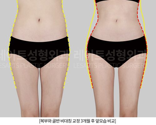 골반지방이식 전후사진 레아트 성형외과