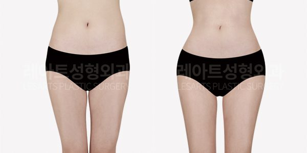 고관절 지방이식 전후사진