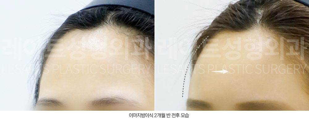 얼굴 지방이식 전후사진 - 레아트 성형외과