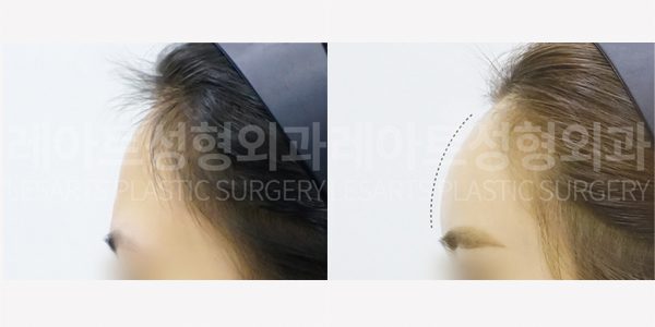 이마 지방이식 전후사진