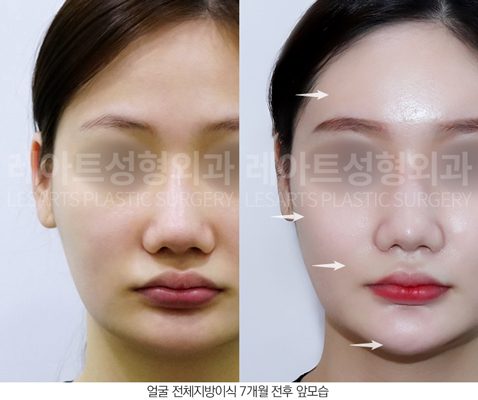 앞볼 지방 이식 전후사진