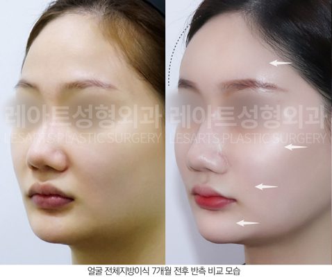 얼굴 지방이식 전후사진