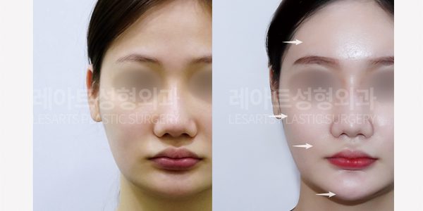 얼굴 지방이식, 이마 지방이식, 팔자 지방이식 전후사진