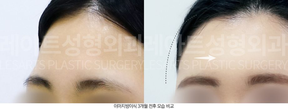 이마 지방이식 전후사진