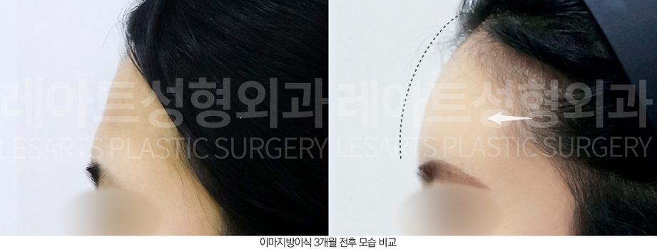 이마 지방이식 전후사진 레아트 성형외과