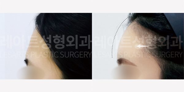 얼굴 지방이식 전후사진