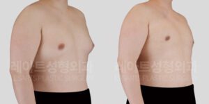 진성 여유증 전후사진 레아트 성형외과