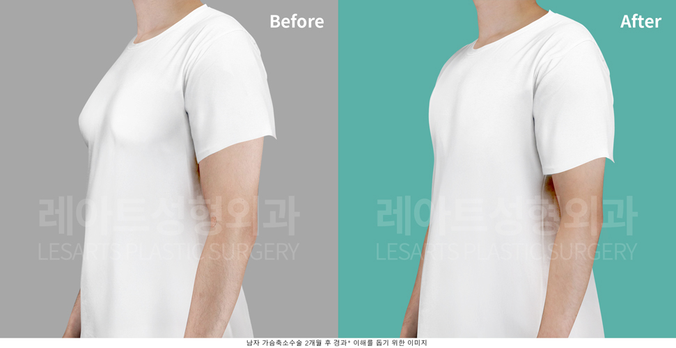 그레이드2-a 여유증 수술 전후사진