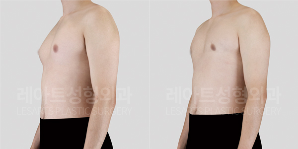 여유증 수술 2개월 후 전후사진 비교
