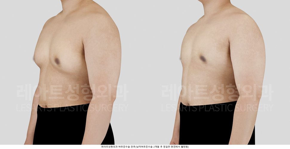 여유증 수술 후 전후사진 - 레아트 성형외과