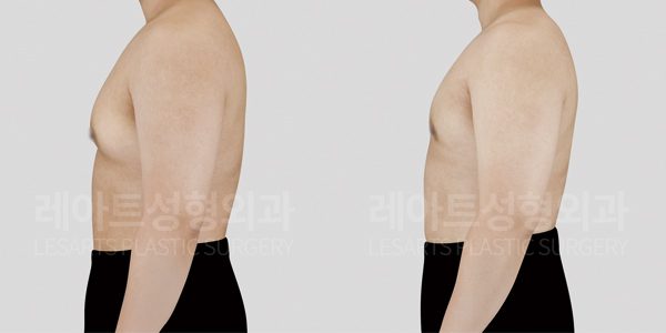 진성 여유증 수술 사례 전후 사진