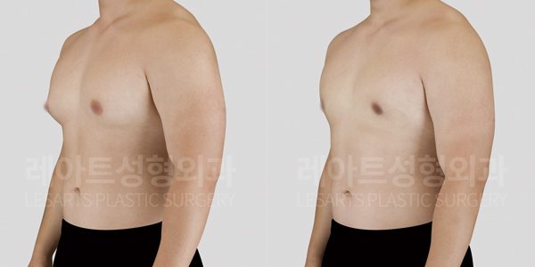 여유증 수술 후 전후 사진