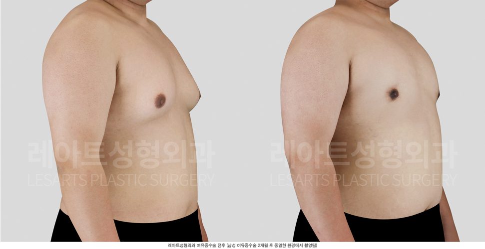 그레이드 2-A 여유증 수술 전후 사례 - 레아트 성형외과