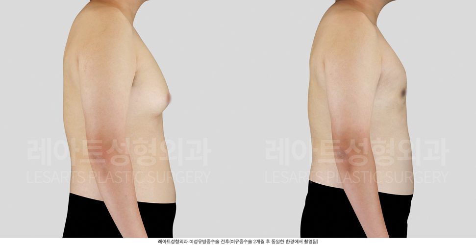 여유증 수술 전후사진 그레이트 2-B 레아트 성형외과